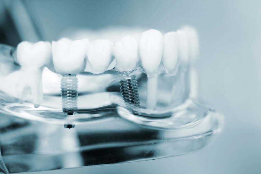 dental implants dentist Puyallup WA